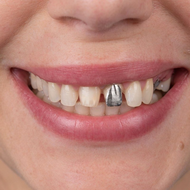 Antes - carillas