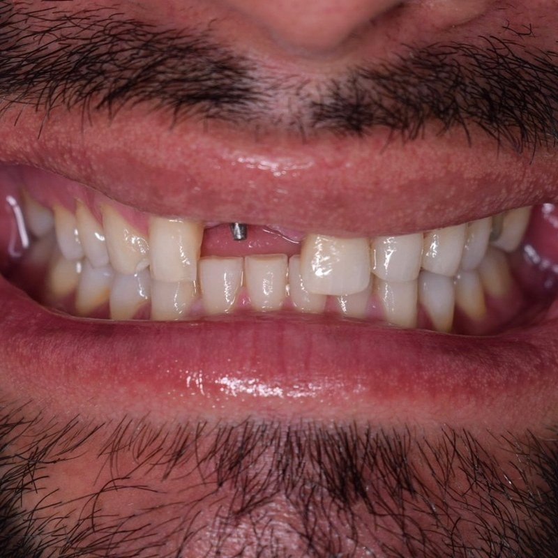Antes - blanqueamiento