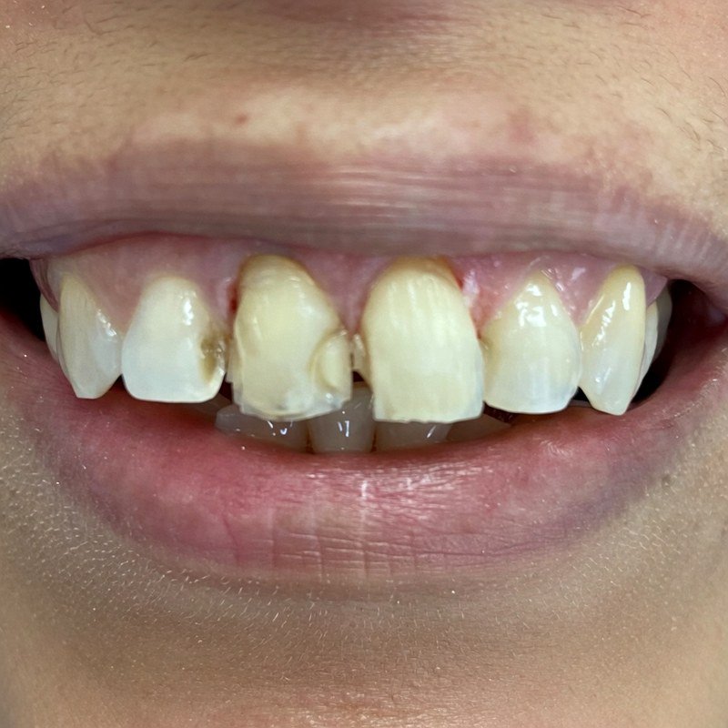Antes - Invisalign